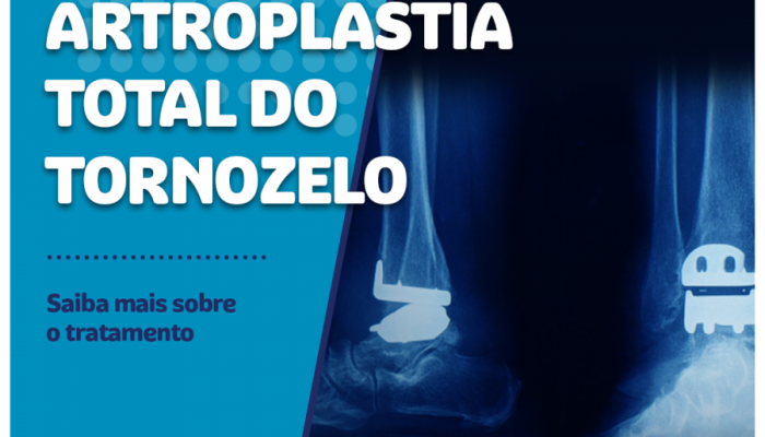Tratamento da artroplastia total do tornozelo